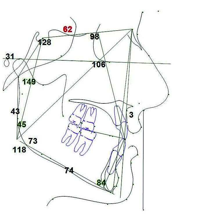Orthodontic management of maxillary lateral incisors agenesis