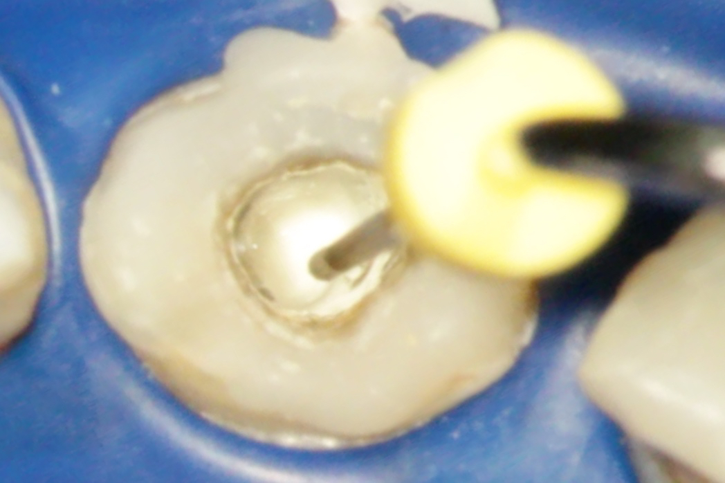 MTA placement with the Produits Dentaires MAP System